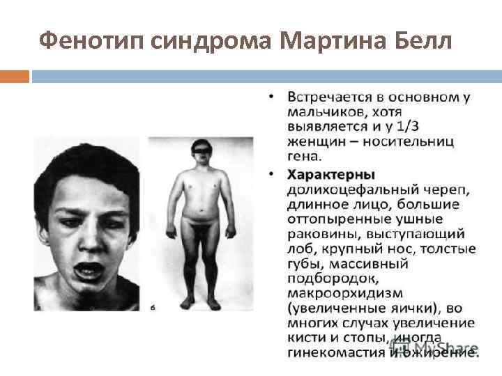 Фенотип синдрома Мартина Белл 