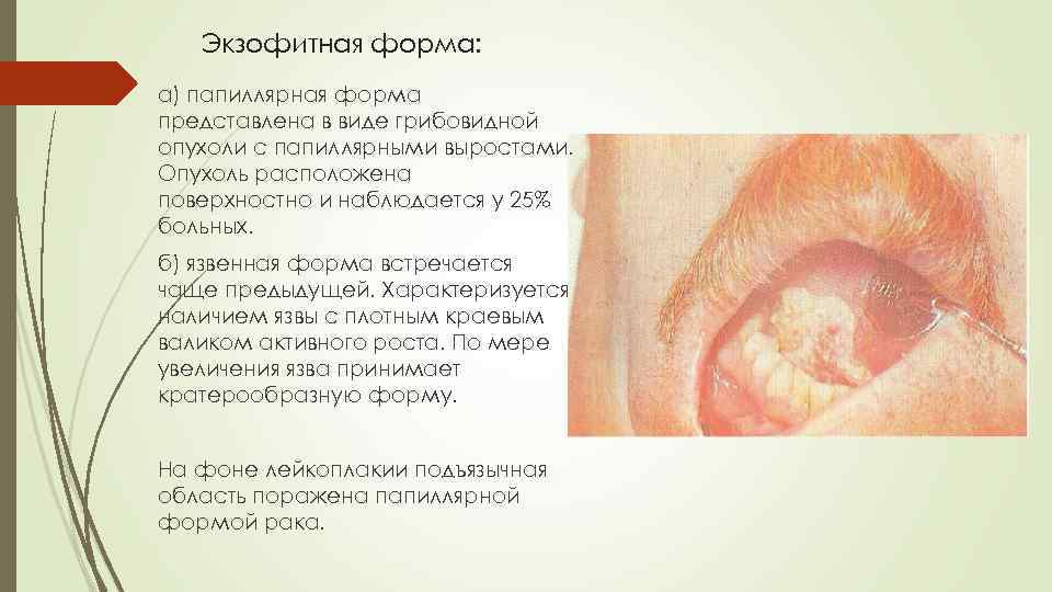Экзофитная форма: а) папиллярная форма представлена в виде грибовидной опухоли с папиллярными выростами. Опухоль