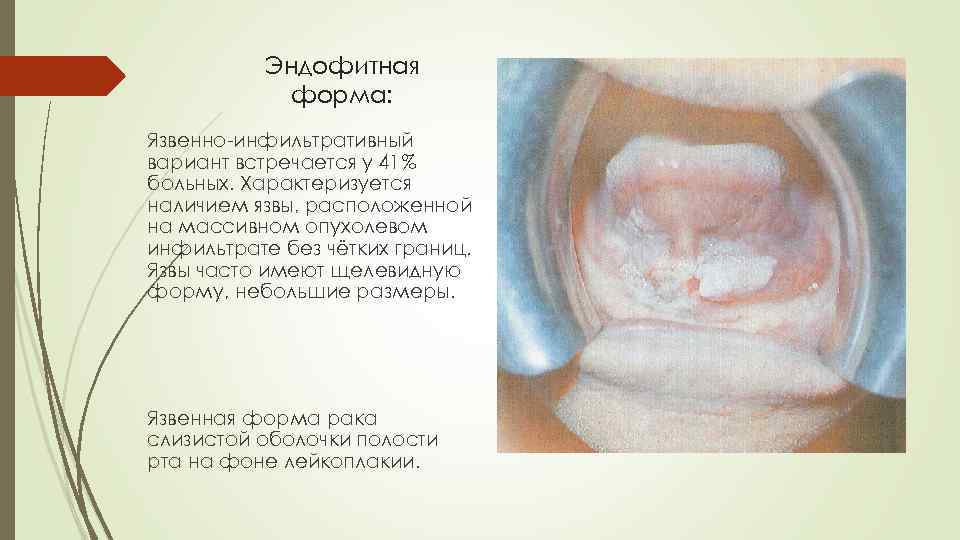 Эндофитная форма: Язвенно-инфильтративный вариант встречается у 41% больных. Характеризуется наличием язвы, расположенной на массивном