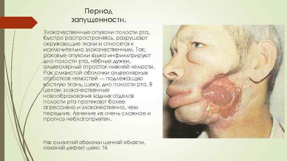 Период запущенности. Злокачественные опухоли полости рта, быстро распространяясь, разрушают окружающие ткани и относятся к
