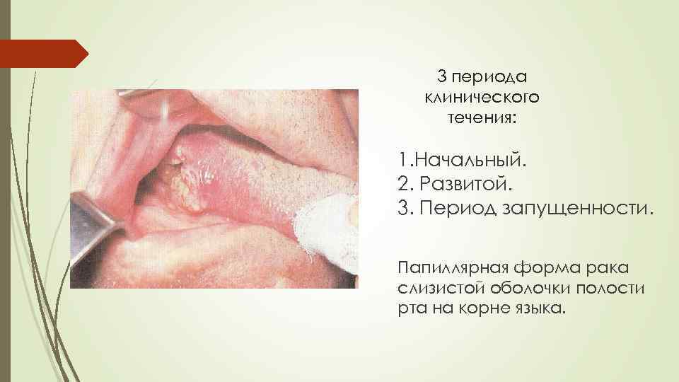 3 периода клинического течения: 1. Начальный. 2. Развитой. 3. Период запущенности. Папиллярная форма рака