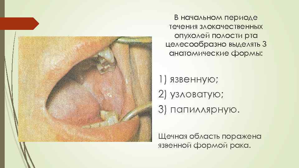 В начальном периоде течения злокачественных опухолей полости рта целесообразно выделять 3 анатомические формы: 1)