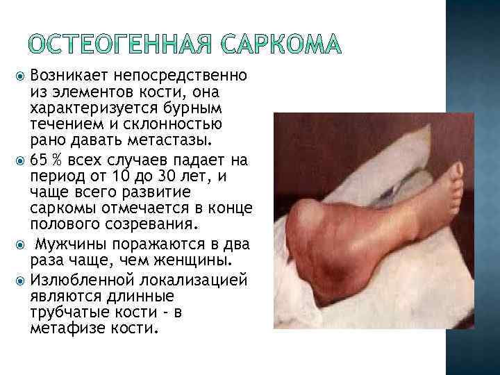 Возникает непосредственно из элементов кости, она характеризуется бурным течением и склонностью рано давать метастазы.