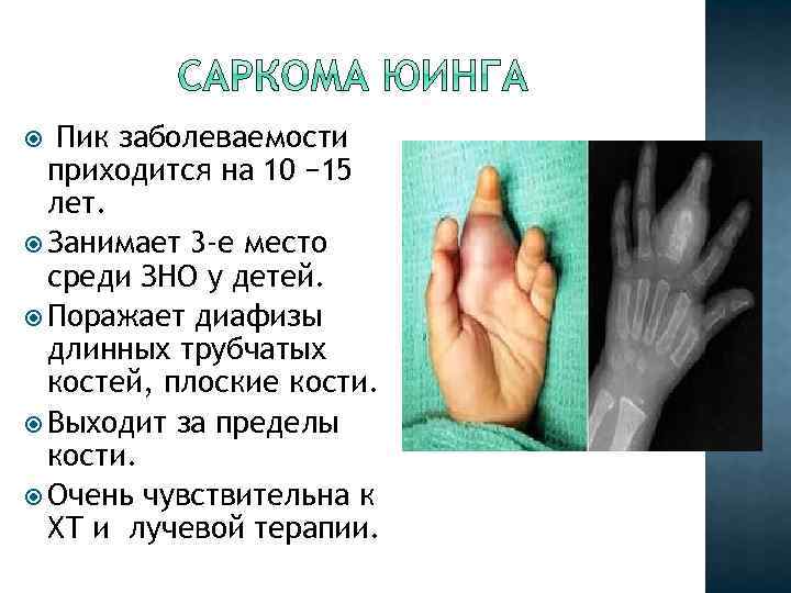  Пик заболеваемости приходится на 10 − 15 лет. Занимает 3 -е место среди