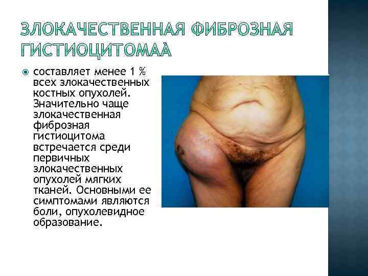  составляет менее 1 % всех злокачественных костных опухолей. Значительно чаще злокачественная фиброзная гистиоцитома