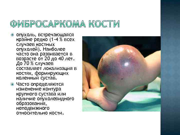  опухоль, встречающаяся крайне редко (1 -4 % всех случаев костных опухолей). Наиболее часто