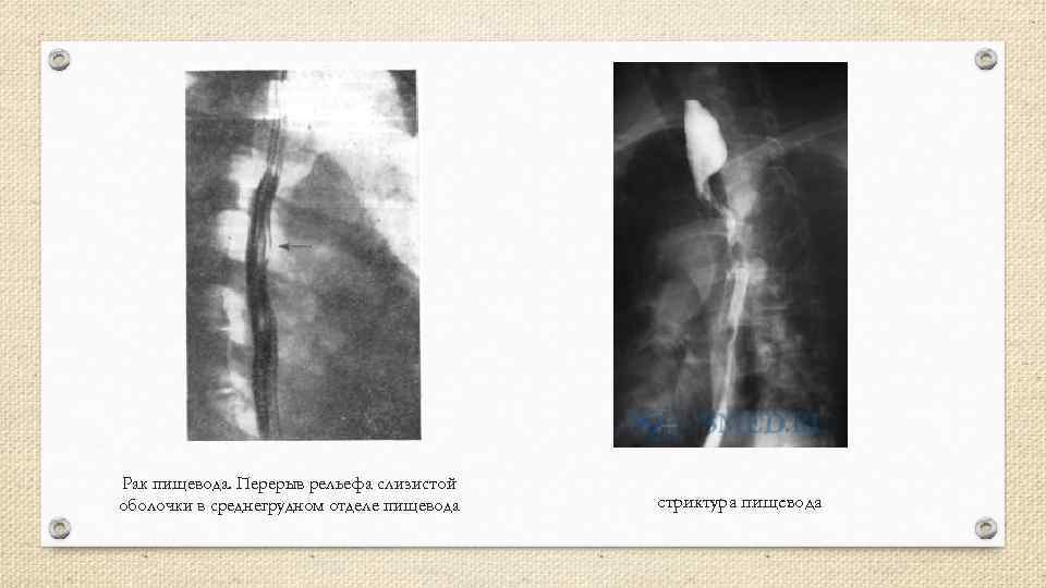 Рак пищевода. Перерыв рельефа слизистой оболочки в среднегрудном отделе пищевода стриктура пищевода 