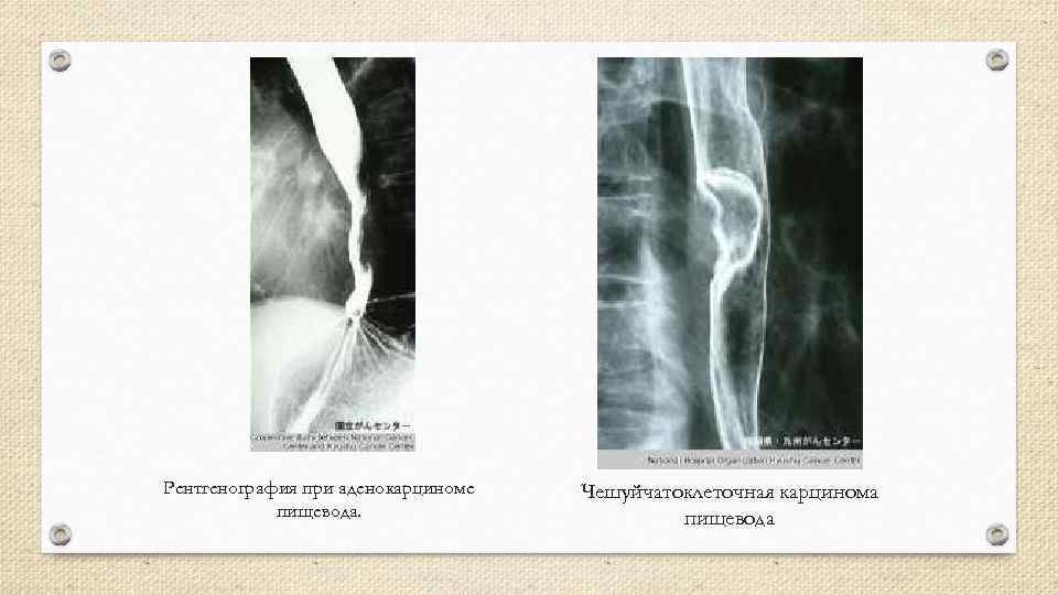 Рентгенография при аденокарциноме пищевода. Чешуйчатоклеточная карцинома пищевода 