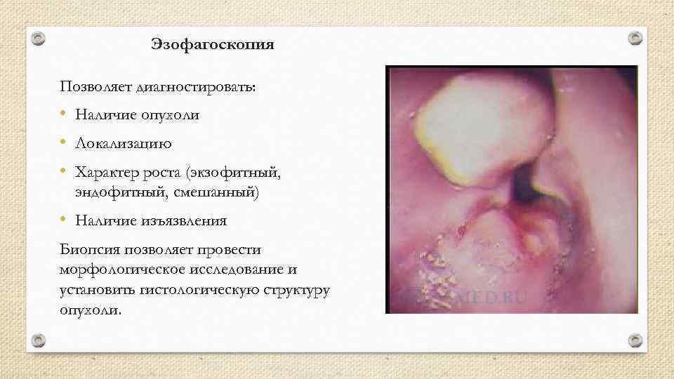 Эзофагоскопия Позволяет диагностировать: • Наличие опухоли • Локализацию • Характер роста (экзофитный, эндофитный, смешанный)