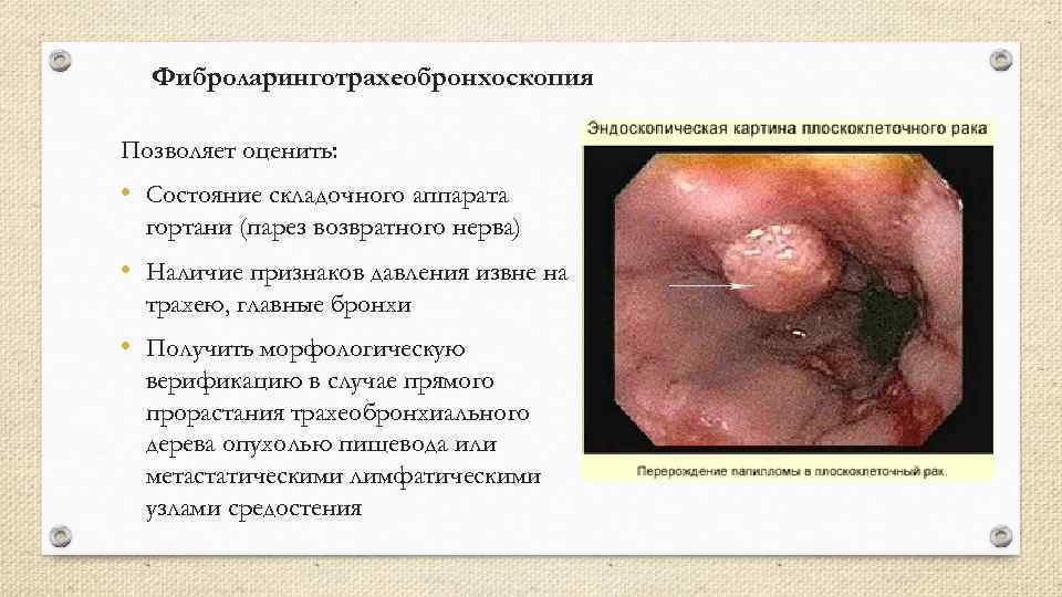 Фиброларинготрахеобронхоскопия Позволяет оценить: • Состояние складочного аппарата гортани (парез возвратного нерва) • Наличие признаков