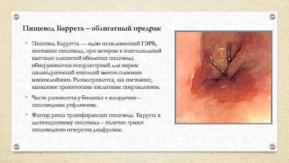 Пищевод Баррета – облигатный предрак • Пищевод Барретта — одно из осложнений ГЭРБ, состояние