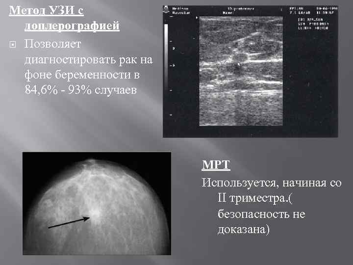 Метод УЗИ с доплерографией Позволяет диагностировать рак на фоне беременности в 84, 6% -