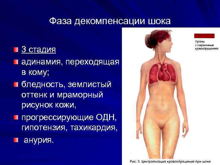 Фаза декомпенсации шока 3 стадия адинамия, переходящая в кому; бледность, землистый оттенк и мраморный