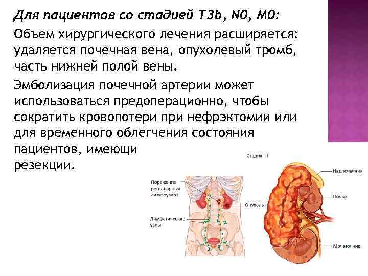 Для пациентов со стадией T 3 b, N 0, M 0: Объем хирургического лечения