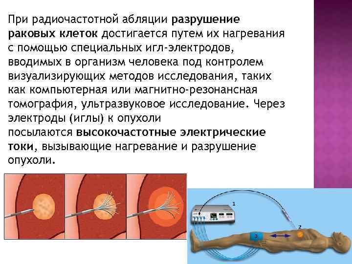 Радиочастотная термоабляция. Чрескожная радиочастотная абляция. Родиочастотная облацич.