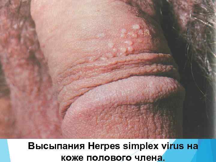 Высыпания Herpes simplex virus на коже полового члена. 