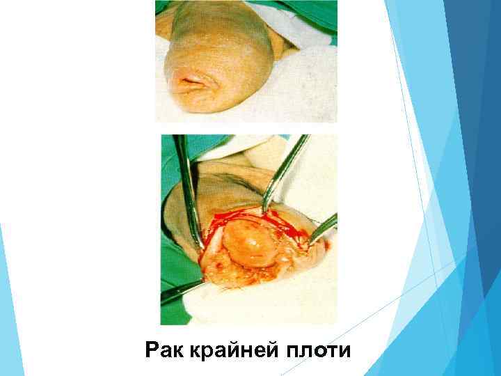 Рак крайней плоти 