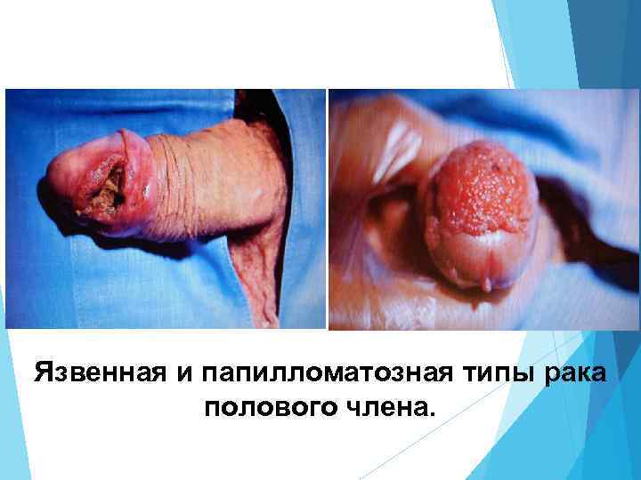 Язвенная и папилломатозная типы рака полового члена. 