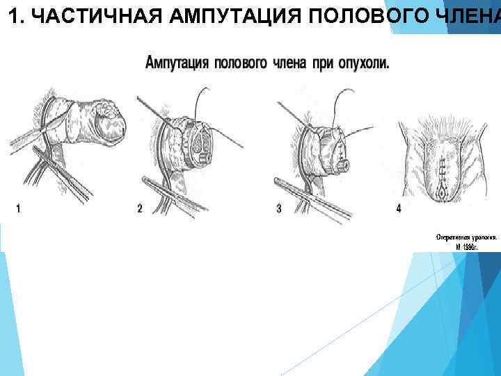 1. ЧАСТИЧНАЯ АМПУТАЦИЯ ПОЛОВОГО ЧЛЕНА 
