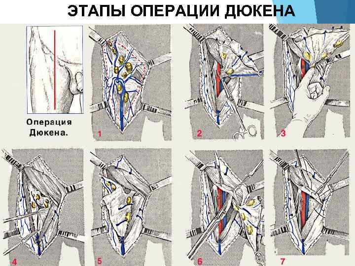 ЭТАПЫ ОПЕРАЦИИ ДЮКЕНА 