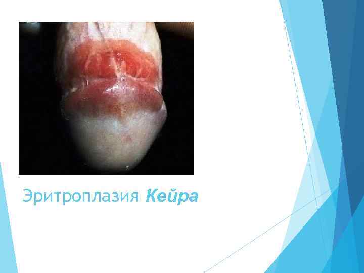 Эритроплазия Кейра 