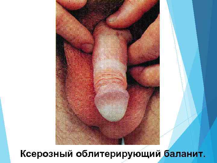 Ксерозный облитерирующий баланит. 