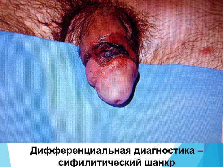 Дифференциальная диагностика – сифилитический шанкр 