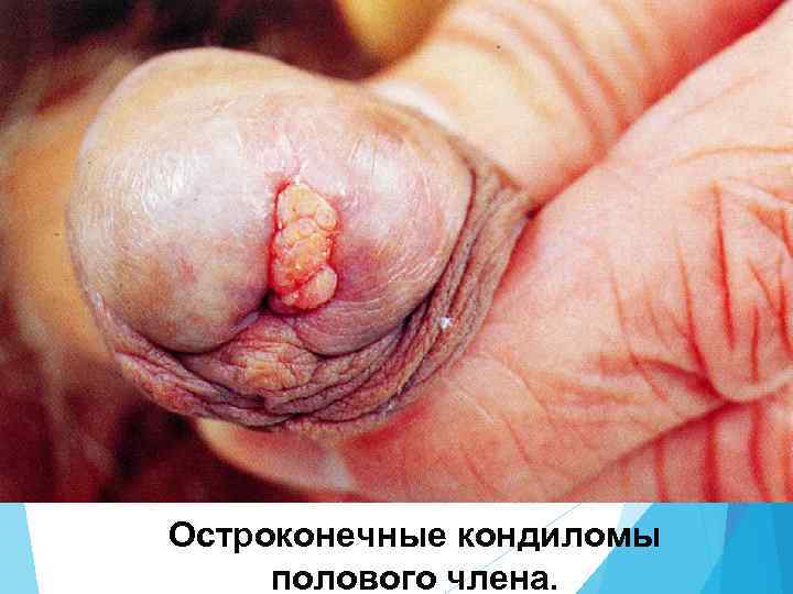 Остроконечные кондиломы полового члена. 