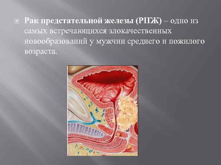 Рак предстательной железы. Злокачественные новообразования простаты. Злокачественная опухоль предстательной железы в пожилом возрасте. Новообразования простаты злокачественной природы.