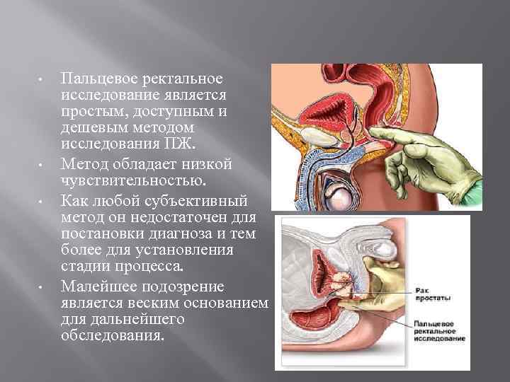  • • Пальцевое ректальное исследование является простым, доступным и дешевым методом исследования ПЖ.