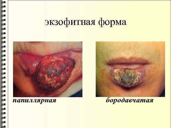 экзофитная форма папиллярная бородавчатая 