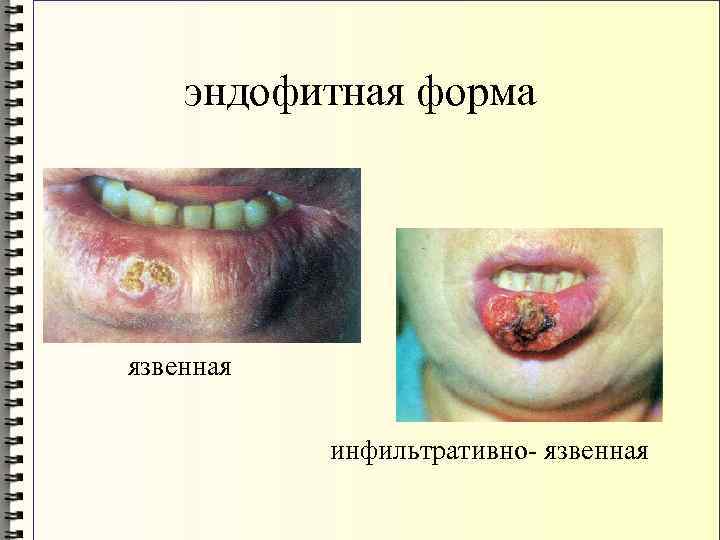 эндофитная форма язвенная инфильтративно- язвенная 
