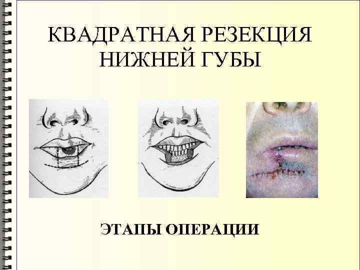 КВАДРАТНАЯ РЕЗЕКЦИЯ НИЖНЕЙ ГУБЫ ЭТАПЫ ОПЕРАЦИИ 