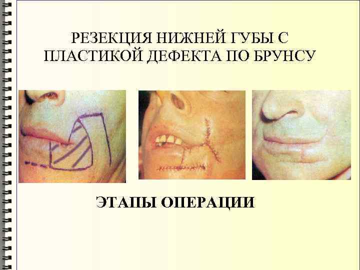 РЕЗЕКЦИЯ НИЖНЕЙ ГУБЫ С ПЛАСТИКОЙ ДЕФЕКТА ПО БРУНСУ ЭТАПЫ ОПЕРАЦИИ 