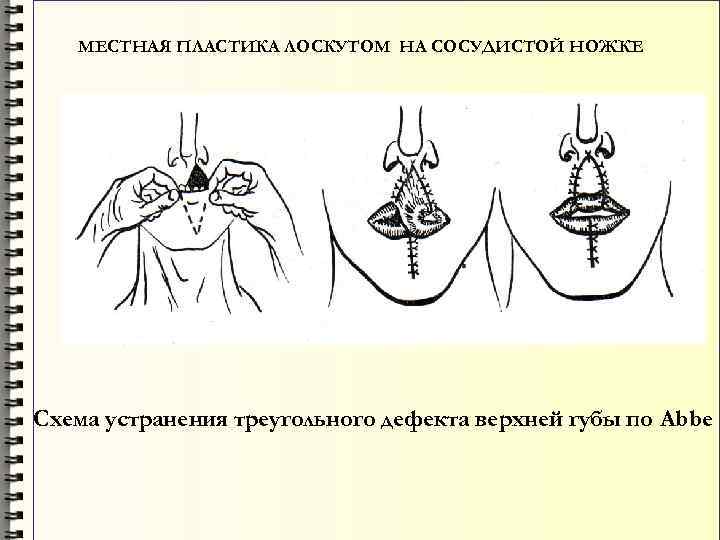 Лоскуты на микрососудистом анастомозе применяемые в челюстно лицевой хирургии презентация