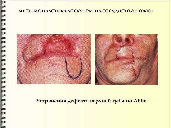 МЕСТНАЯ ПЛАСТИКА ЛОСКУТОМ НА СОСУДИСТОЙ НОЖКЕ Устранения дефекта верхней губы по Abbe 