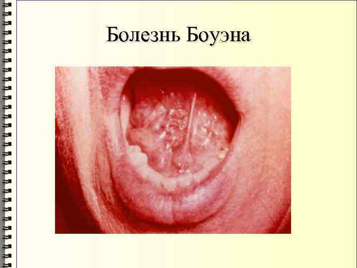 Болезнь Боуэна 