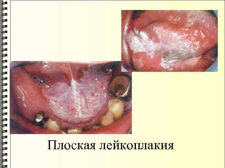 Плоская лейкоплакия 