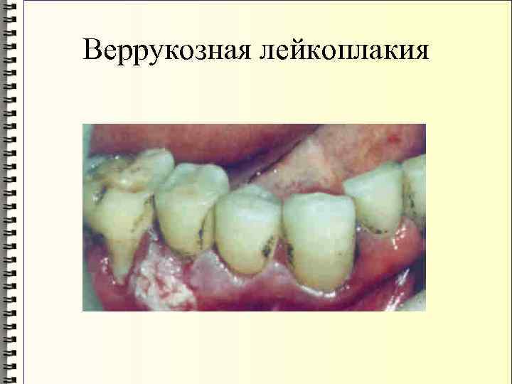 Веррукозная лейкоплакия 