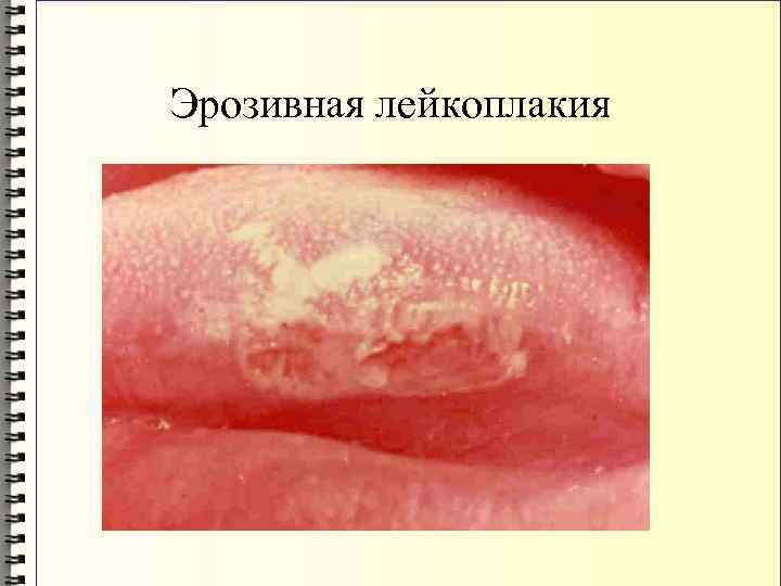 Эрозивная лейкоплакия 