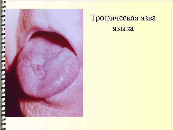 Трофическая язва языка 