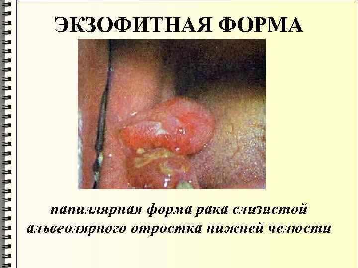 ЭКЗОФИТНАЯ ФОРМА папиллярная форма рака слизистой альвеолярного отростка нижней челюсти 