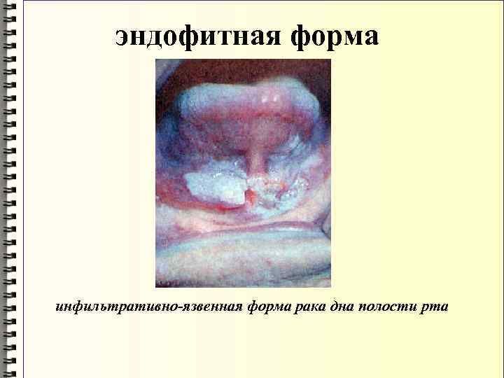 эндофитная форма инфильтративно-язвенная форма рака дна полости рта 