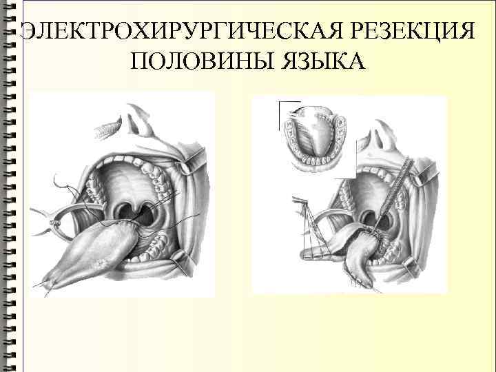 ЭЛЕКТРОХИРУРГИЧЕСКАЯ РЕЗЕКЦИЯ ПОЛОВИНЫ ЯЗЫКА 