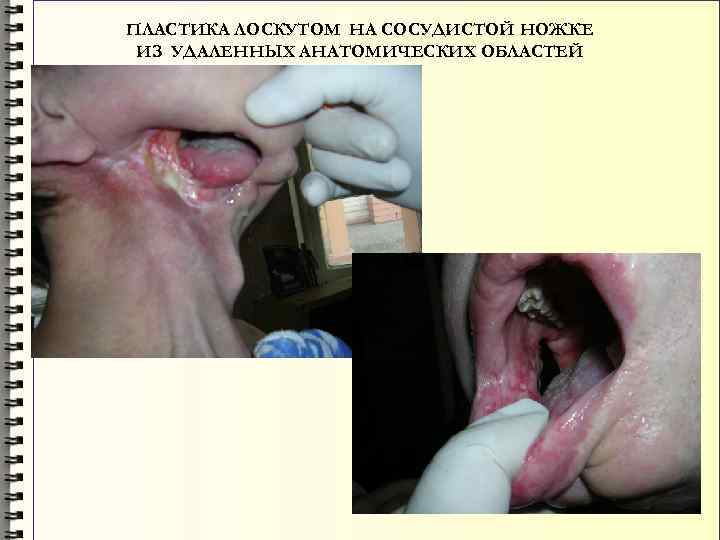 ПЛАСТИКА ЛОСКУТОМ НА СОСУДИСТОЙ НОЖКЕ ИЗ УДАЛЕННЫХ АНАТОМИЧЕСКИХ ОБЛАСТЕЙ 