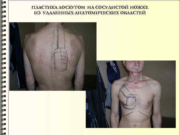 ПЛАСТИКА ЛОСКУТОМ НА СОСУДИСТОЙ НОЖКЕ ИЗ УДАЛЕННЫХ АНАТОМИЧЕСКИХ ОБЛАСТЕЙ 