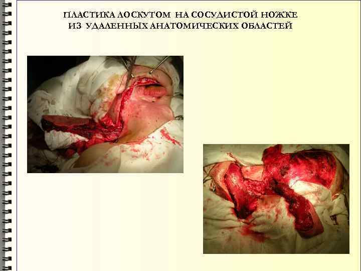 ПЛАСТИКА ЛОСКУТОМ НА СОСУДИСТОЙ НОЖКЕ ИЗ УДАЛЕННЫХ АНАТОМИЧЕСКИХ ОБЛАСТЕЙ 