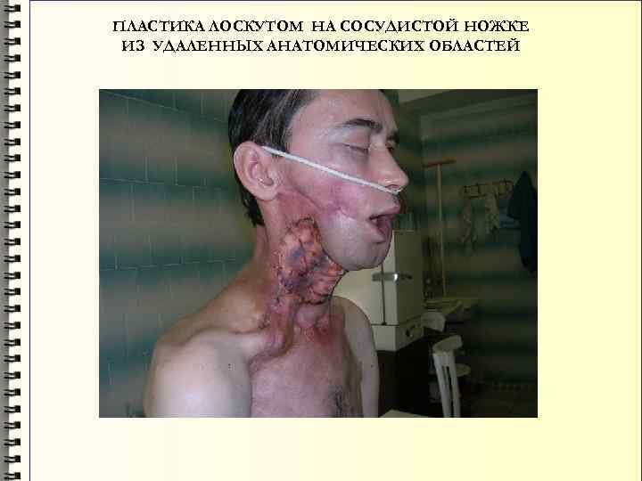 ПЛАСТИКА ЛОСКУТОМ НА СОСУДИСТОЙ НОЖКЕ ИЗ УДАЛЕННЫХ АНАТОМИЧЕСКИХ ОБЛАСТЕЙ 