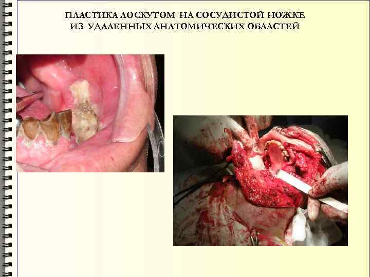 ПЛАСТИКА ЛОСКУТОМ НА СОСУДИСТОЙ НОЖКЕ ИЗ УДАЛЕННЫХ АНАТОМИЧЕСКИХ ОБЛАСТЕЙ 