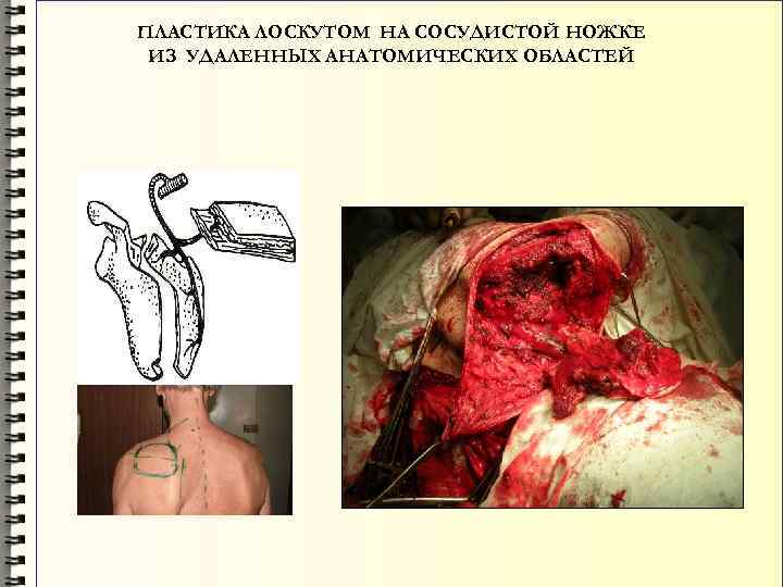 ПЛАСТИКА ЛОСКУТОМ НА СОСУДИСТОЙ НОЖКЕ ИЗ УДАЛЕННЫХ АНАТОМИЧЕСКИХ ОБЛАСТЕЙ 
